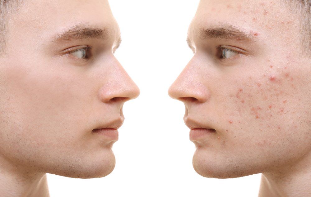 MyExceptionalSkinCare.com has the products recommended by dermatologists for controlling acne