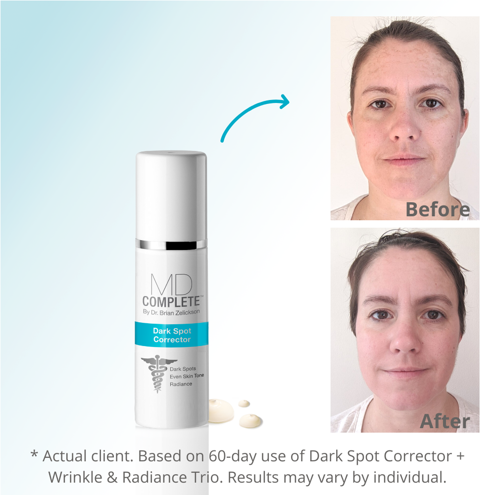 MD Complete Dark Spot Corrector (No Hydroquinone) from MyExceptionalSkinCare.com Before and After
