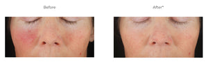 Revision Skincare C+ Correcting Complex from MyExceptionalSkinCare.com Before and After