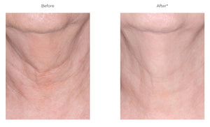 Revision Skincare Nectifirm Original from MyExceptionalSkinCare.com Before and After